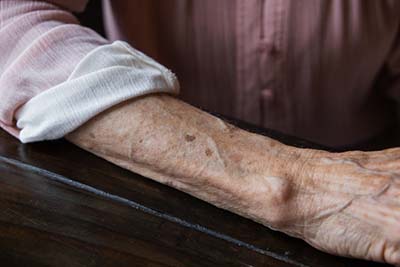 older woman showing aging spots on arm