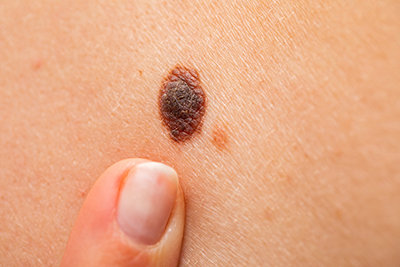 pointing to a melanoma spot/mole