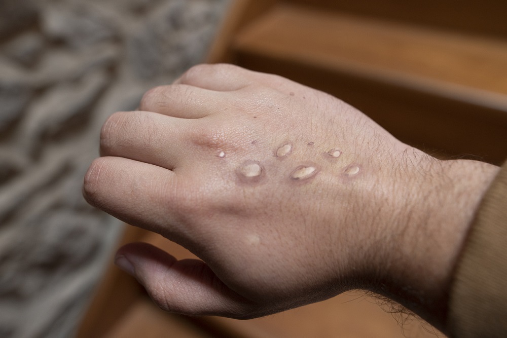 Monkeypox Vesicles on hand