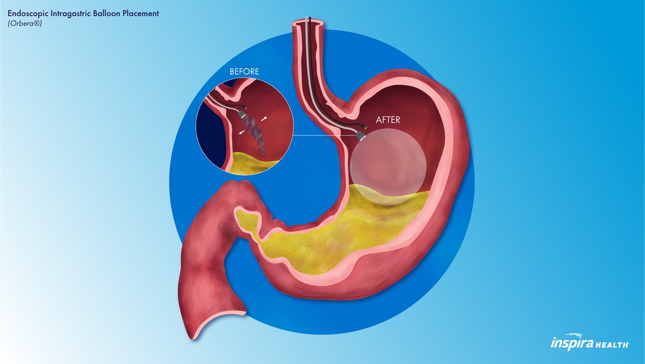 Endoscopic Intragastric Balloon Placement (Orbera®) Illustration Inspira Health