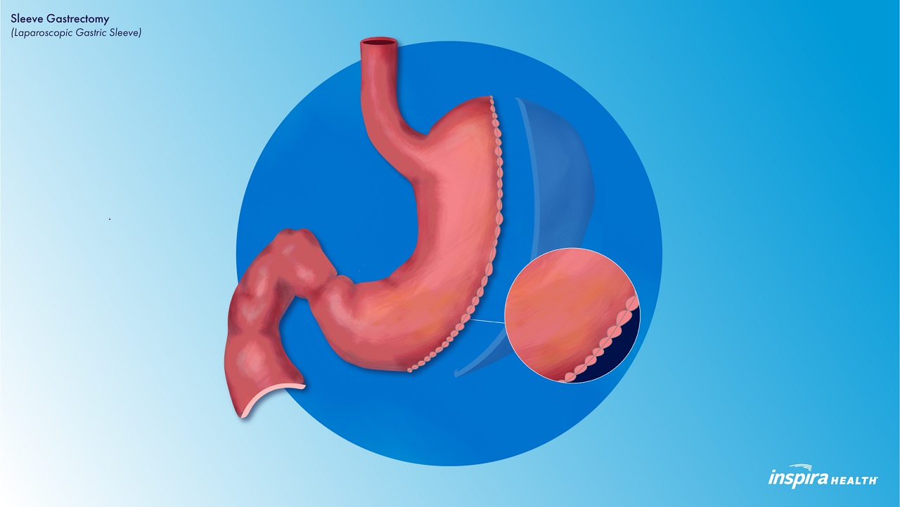 Sleeve Gastrectomy (Laparoscopic Gastric Sleeve) Illustration Inspira Health