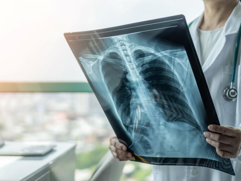 Physician examining a chest x-ray