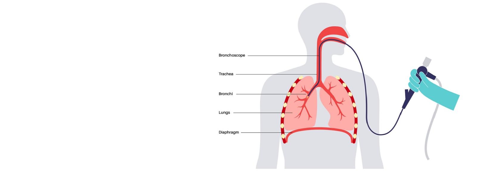 Bronchoscopy vs. Endoscopy Which Diagnostic Procedure Is Right for You