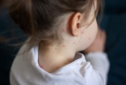 Small Girl With Chickenpox Measles on Her Body