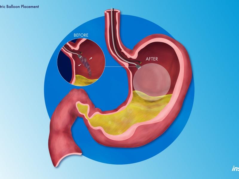 Endoscopic Intragastric Balloon Placement (Orbera®) Illustration Inspira Health