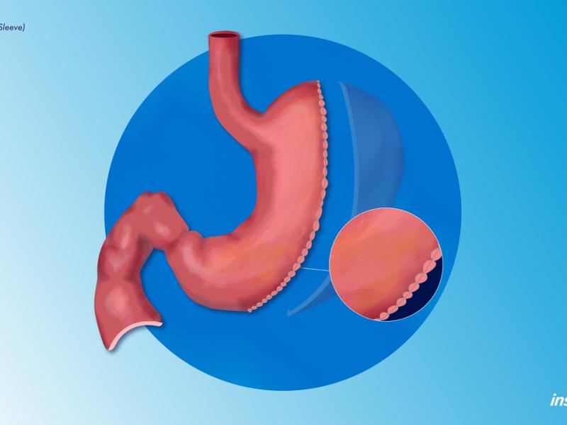 Sleeve Gastrectomy (Laparoscopic Gastric Sleeve) Illustration Inspira Health