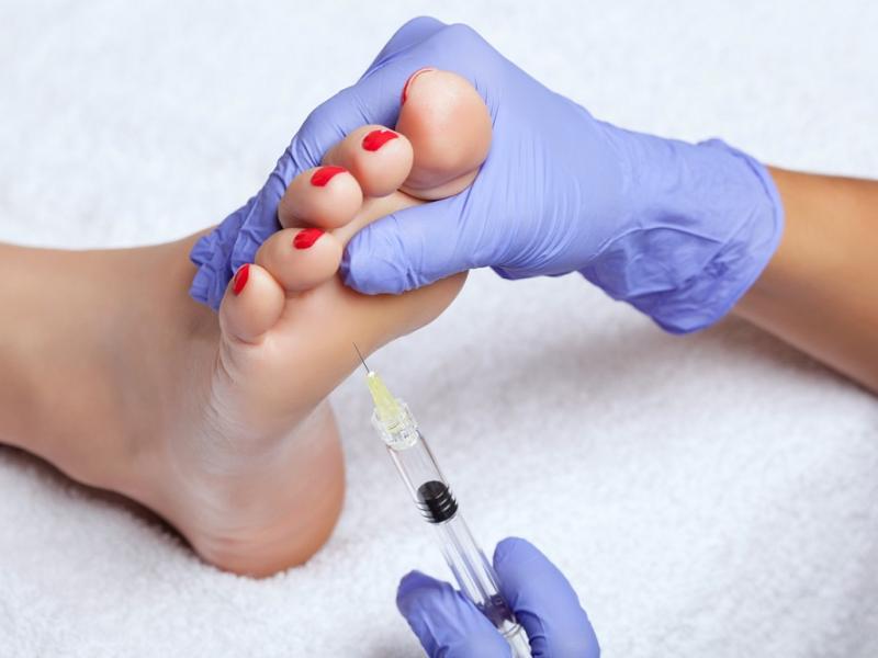 Foot Steroid Injection