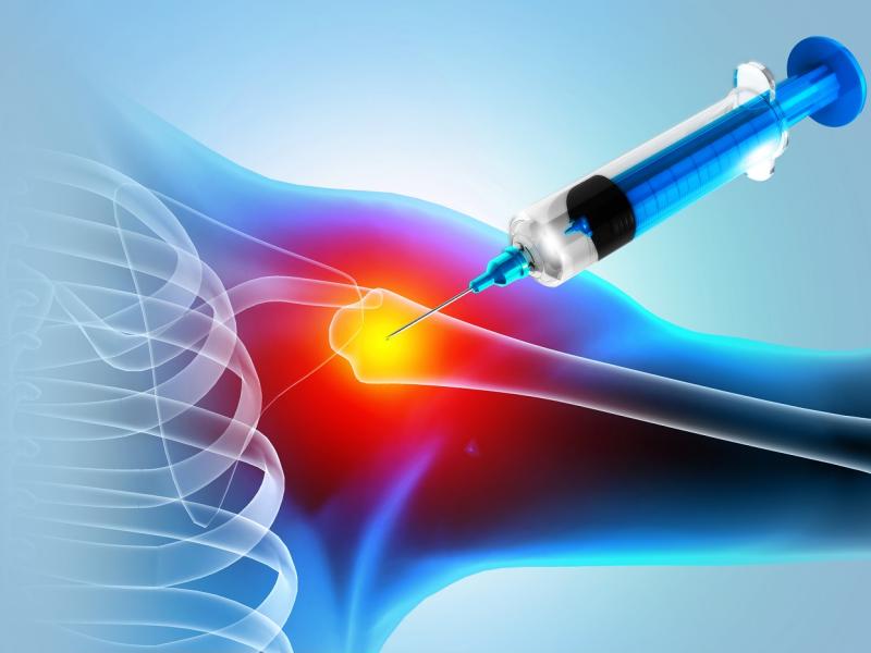 Platelet-Rich Plasma (PRP) Therapy