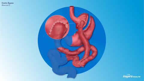 Gastric Bypass (Roux-en-Y) | Inspira Health